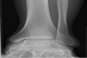 Ein Röntgenbild, das ein menschliches Bein mit einer sichtbaren Fraktur im Knöchel zeigt, wobei die Knochen und Bänder im Detail zu sehen sind.