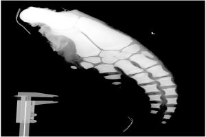 Ein Röntgenbild eines Mannes mit einer Fraktur in der Mitte, mit einem Metallband auf der linken Seite, vor einem schwarzen Hintergrund.